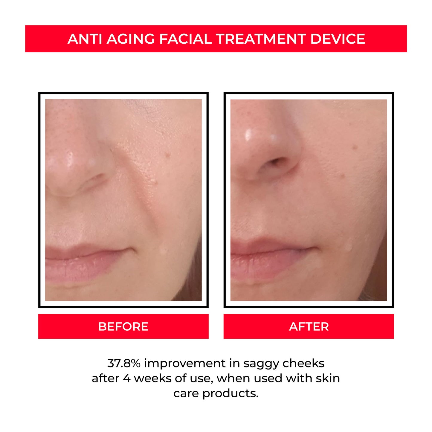 Before and after close-up of facial skin showing reduced saggy cheeks after anti aging treatment