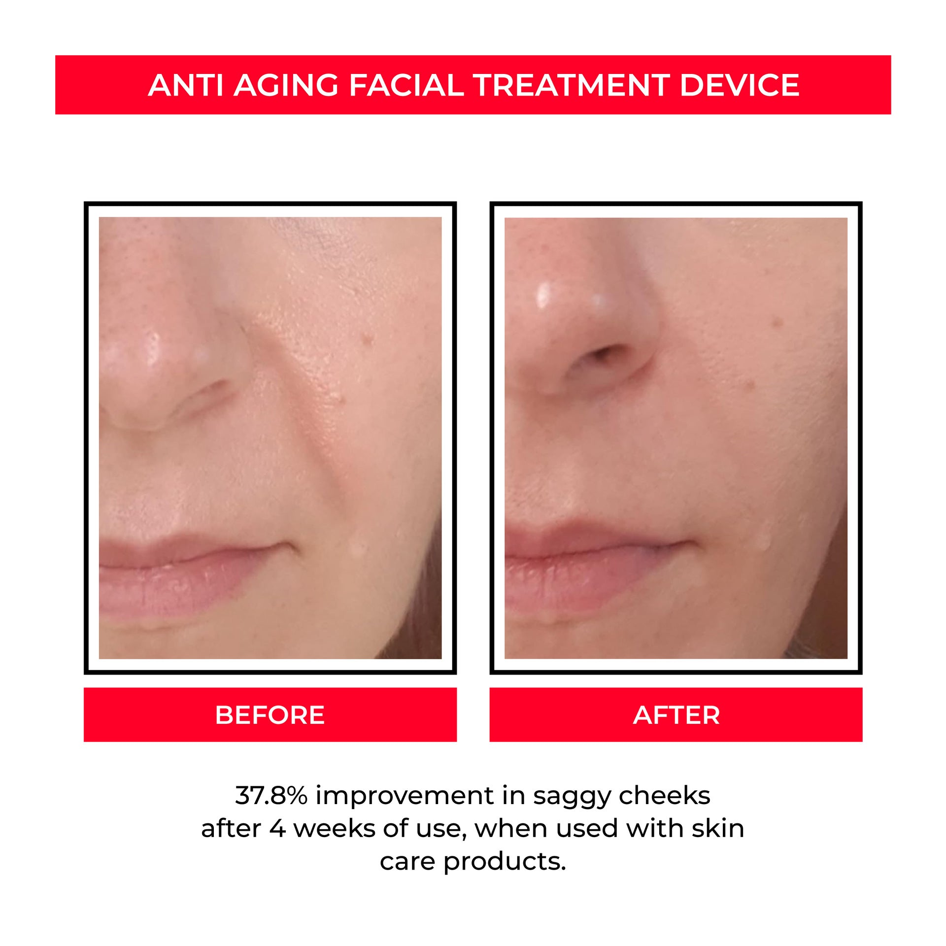 Before and after close-up of facial skin showing reduced saggy cheeks after anti aging treatment
