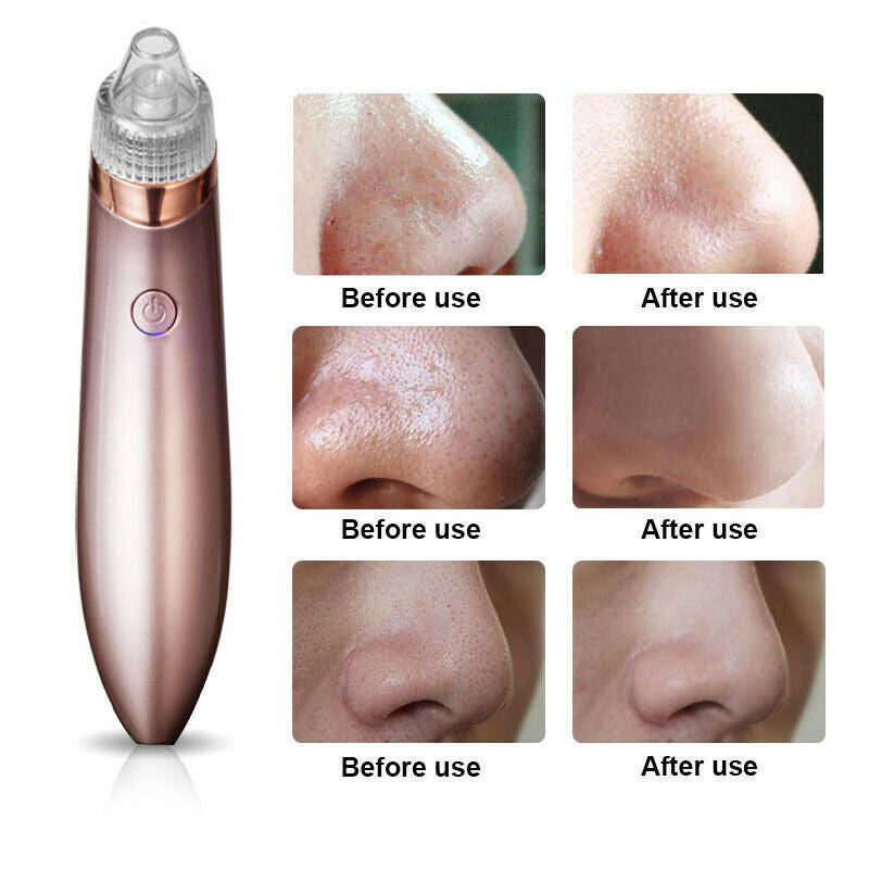 Electric blackhead remover device with before and after nose photos showing clear skin results
