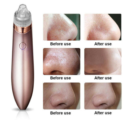 Electric blackhead remover device with before and after nose photos showing clear skin results